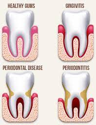Periodontal & Gum Surgery