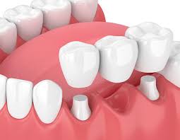 crown-and-bridge-work/