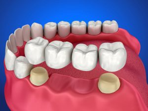 crown-and-bridge-work/