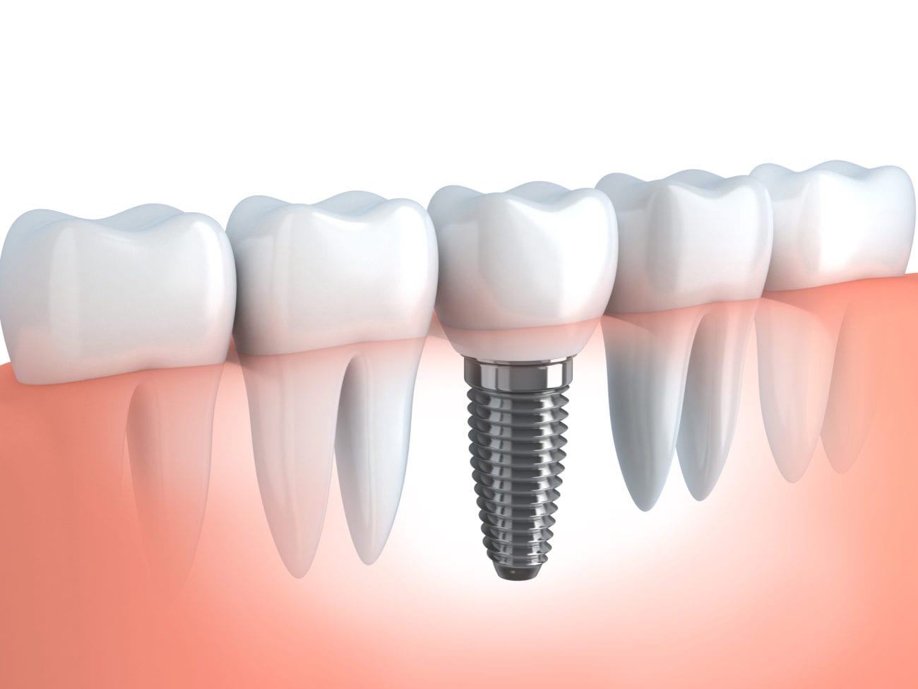 Implant Insertion: Everything You Need to Know