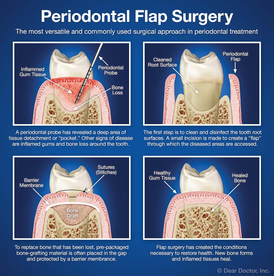 Periodontal & Gum Surgery: A Complete Guide
