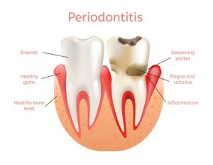 Periodontal & Gum Surgery