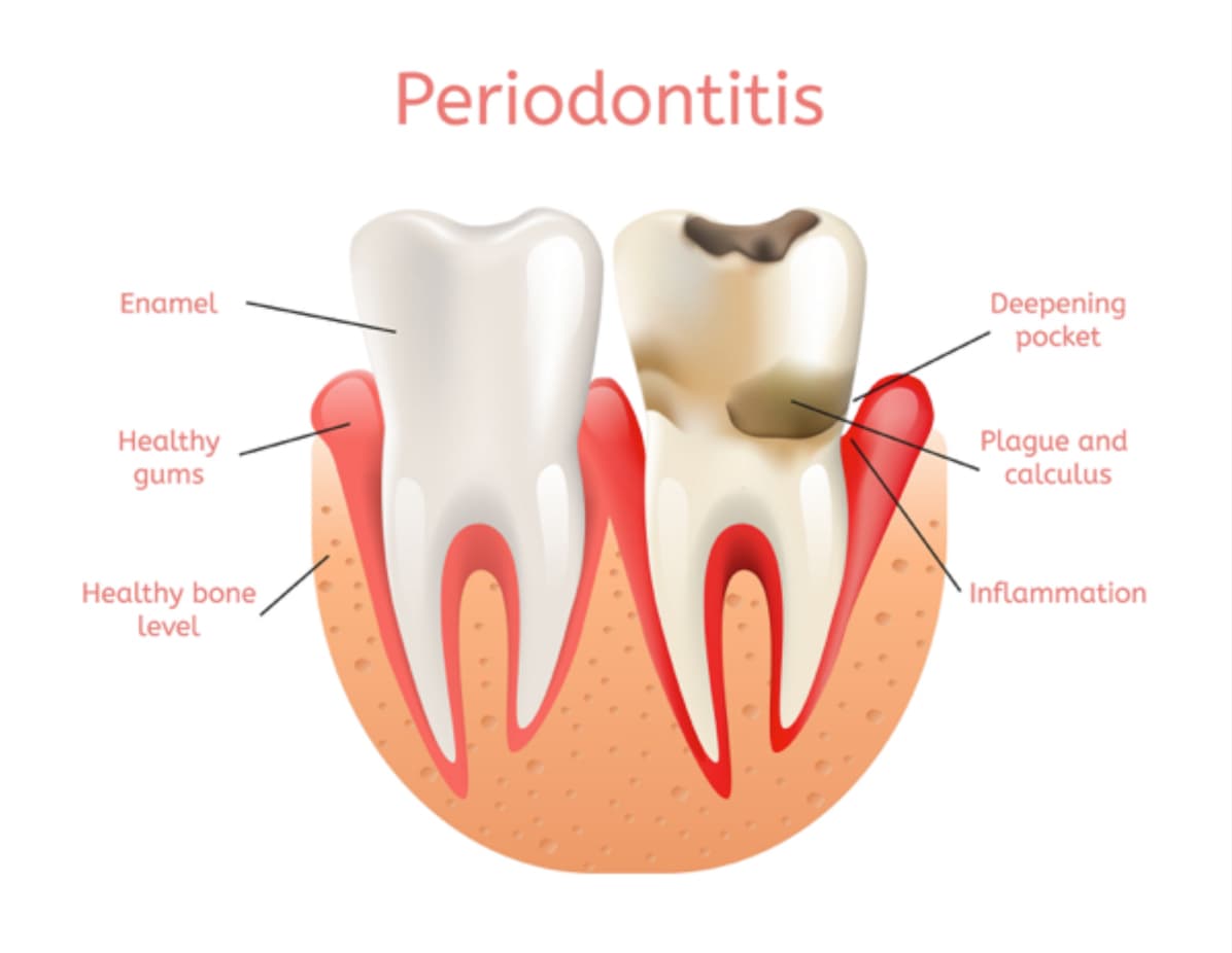periodontitis-treatment 3