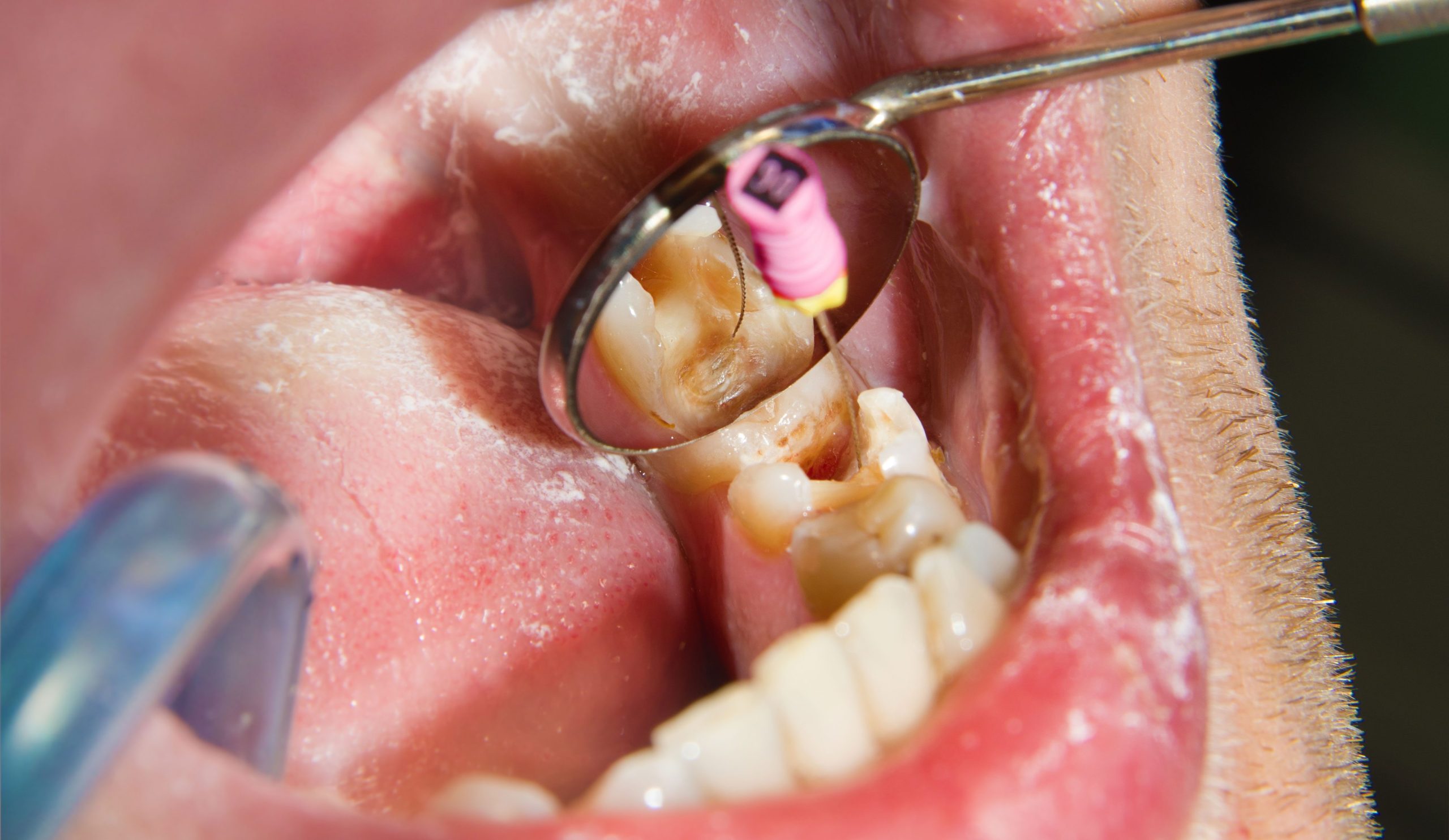Oral Surgical Treatment: An Overview